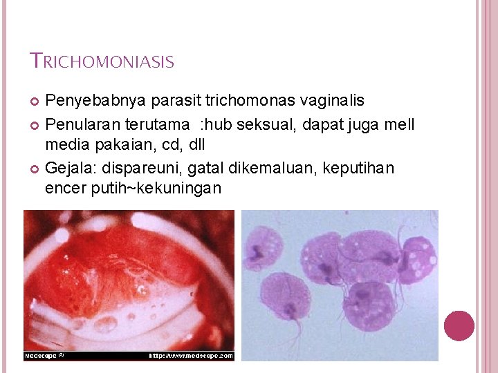 TRICHOMONIASIS Penyebabnya parasit trichomonas vaginalis Penularan terutama : hub seksual, dapat juga mell media