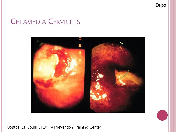 Drips CHLAMYDIA CERVICITIS Source: St. Louis STD/HIV Prevention Training Center 