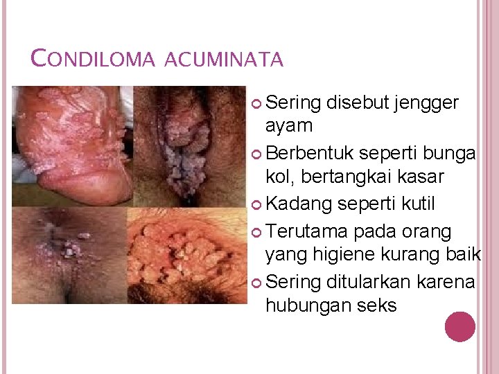 CONDILOMA ACUMINATA Sering disebut jengger ayam Berbentuk seperti bunga kol, bertangkai kasar Kadang seperti