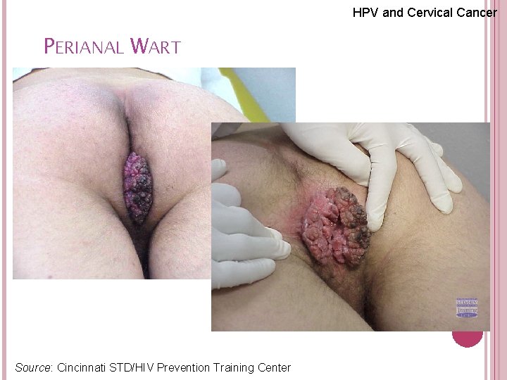 HPV and Cervical Cancer PERIANAL WART 59 Source: Cincinnati STD/HIV Prevention Training Center 