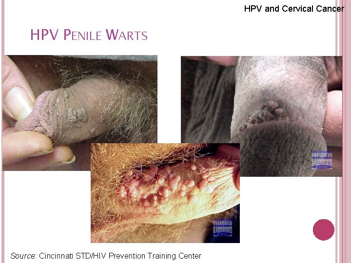 HPV and Cervical Cancer HPV PENILE WARTS 60 Source: Cincinnati STD/HIV Prevention Training Center