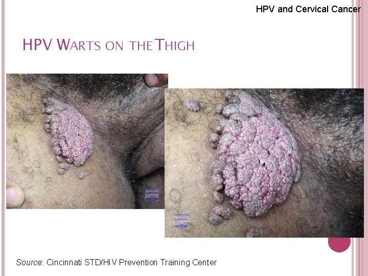 HPV and Cervical Cancer HPV WARTS ON THE THIGH 61 Source: Cincinnati STD/HIV Prevention