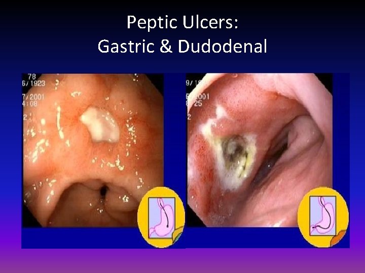 Peptic Ulcers: Gastric & Dudodenal 