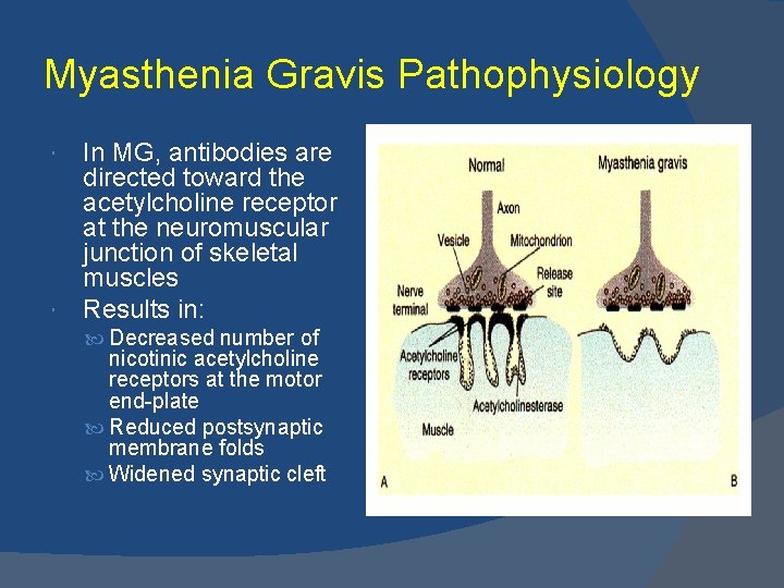 Myasthenia Gravis Pathophysiology In MG, antibodies are directed toward the acetylcholine receptor at the