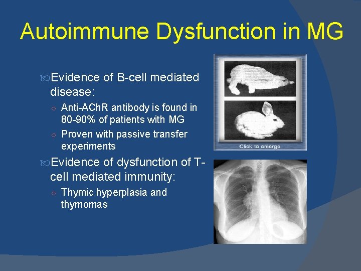 Autoimmune Dysfunction in MG Evidence of B-cell mediated disease: ○ Anti-ACh. R antibody is