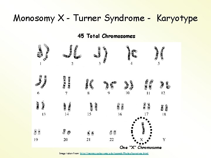 Monosomy X - Turner Syndrome - Karyotype 45 Total Chromosomes One “X” Chromosome Image