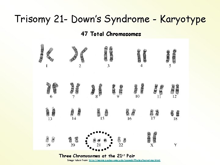 Trisomy 21 - Down’s Syndrome - Karyotype 47 Total Chromosomes Three Chromosomes at the