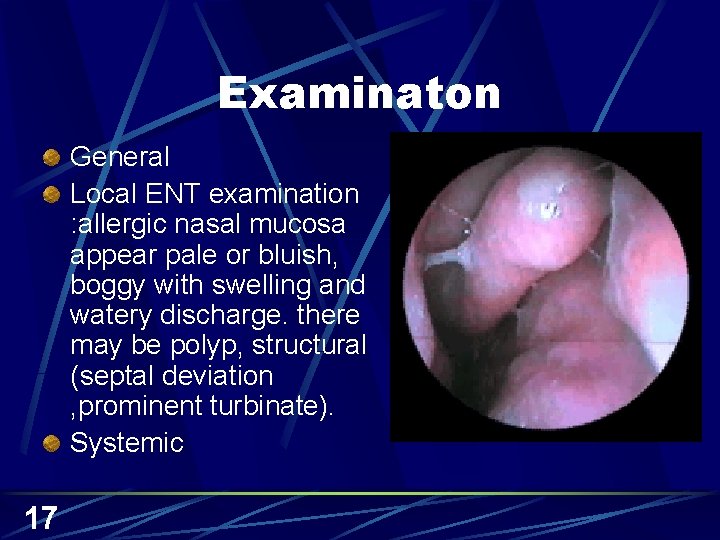 Examinaton General Local ENT examination : allergic nasal mucosa appear pale or bluish, boggy