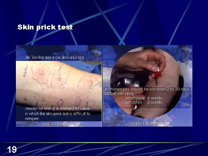 Skin prick test 19 