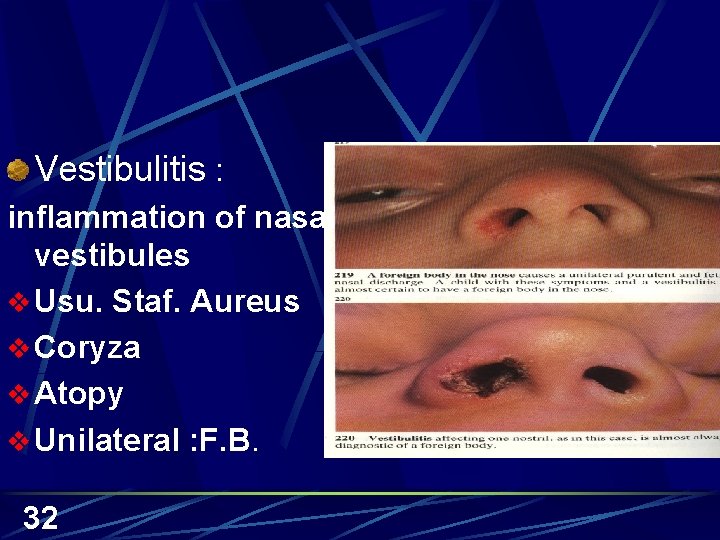 Vestibulitis : inflammation of nasal vestibules v Usu. Staf. Aureus v Coryza v Atopy