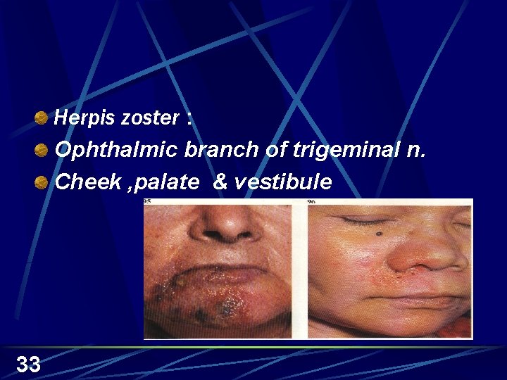 Herpis zoster : Ophthalmic branch of trigeminal n. Cheek , palate & vestibule 33