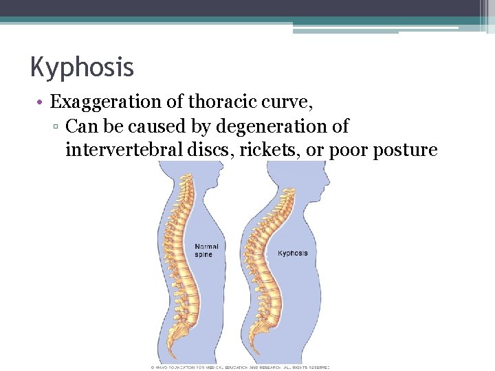 Kyphosis • Exaggeration of thoracic curve, ▫ Can be caused by degeneration of intervertebral