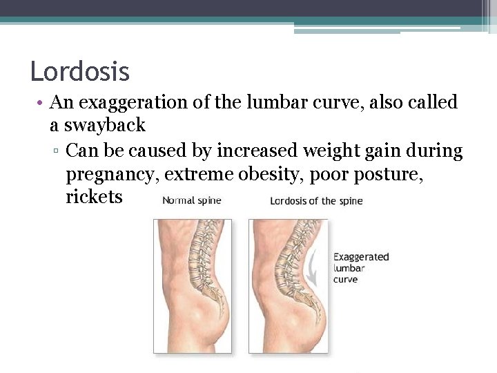 Lordosis • An exaggeration of the lumbar curve, also called a swayback ▫ Can