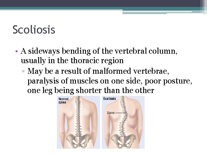 Scoliosis • A sideways bending of the vertebral column, usually in the thoracic region
