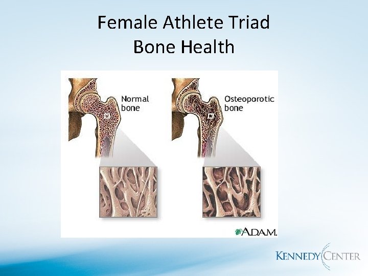 Female Athlete Triad Bone Health 