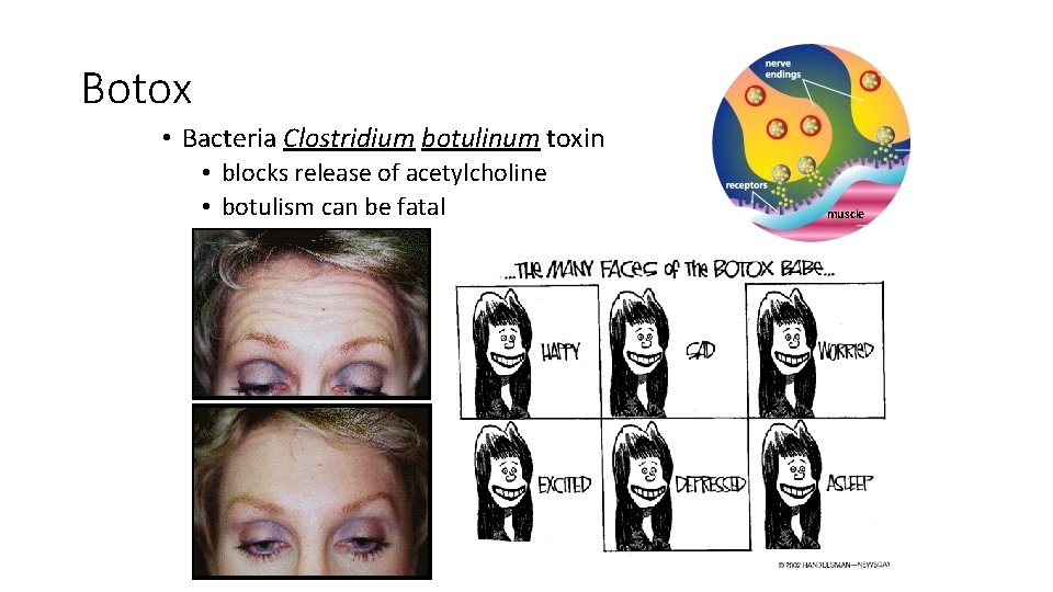 Botox • Bacteria Clostridium botulinum toxin • blocks release of acetylcholine • botulism can