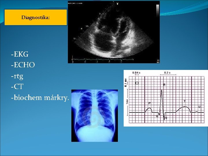 Diagnostika: -EKG -ECHO -rtg -CT -biochem márkry. 
