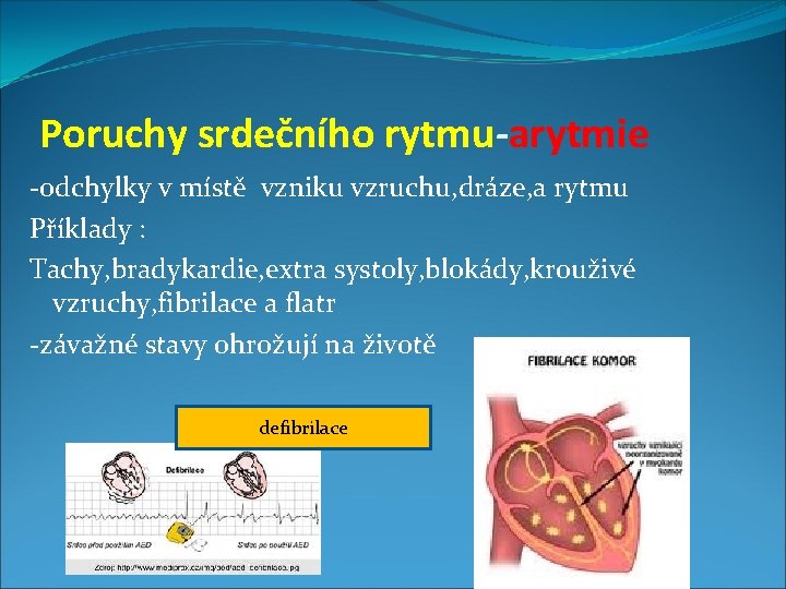 Poruchy srdečního rytmu-arytmie -odchylky v místě vzniku vzruchu, dráze, a rytmu Příklady : Tachy,