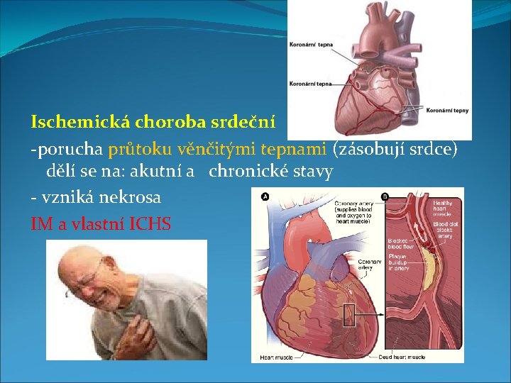 Ischemická choroba srdeční -porucha průtoku věnčitými tepnami (zásobují srdce) dělí se na: akutní a