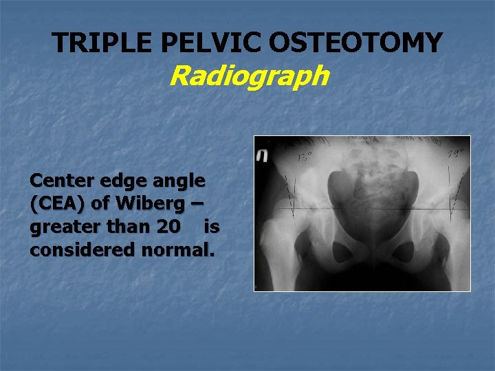 TRIPLE PELVIC OSTEOTOMY Radiograph Center edge angle (CEA) of Wiberg – greater than 20