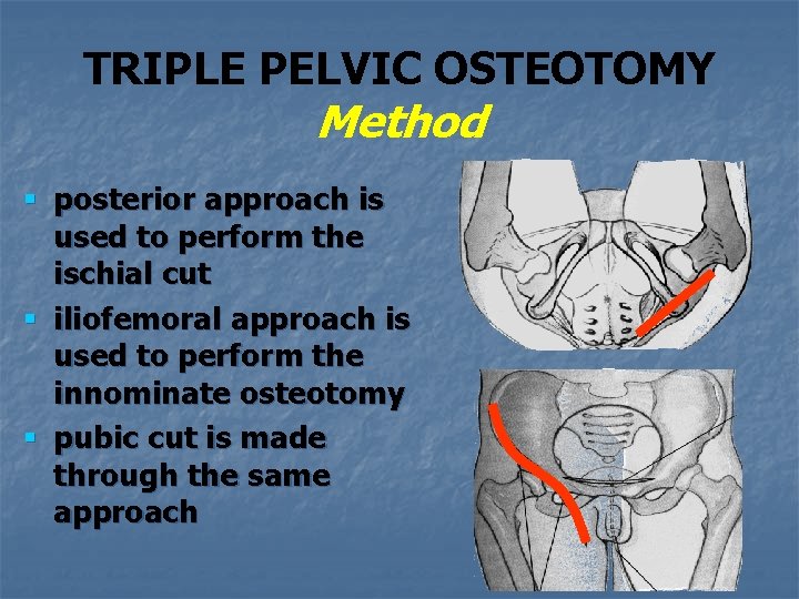TRIPLE PELVIC OSTEOTOMY Method § posterior approach is used to perform the ischial cut