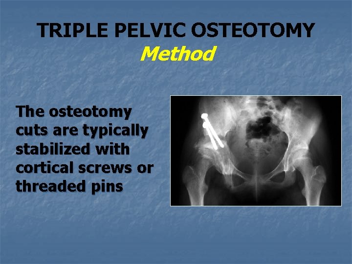 TRIPLE PELVIC OSTEOTOMY Method The osteotomy cuts are typically stabilized with cortical screws or