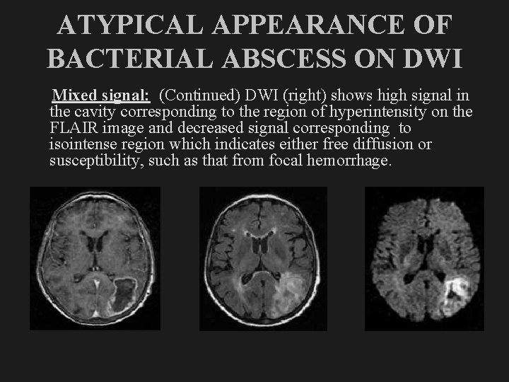 ATYPICAL APPEARANCE OF BACTERIAL ABSCESS ON DWI Mixed signal: (Continued) DWI (right) shows high