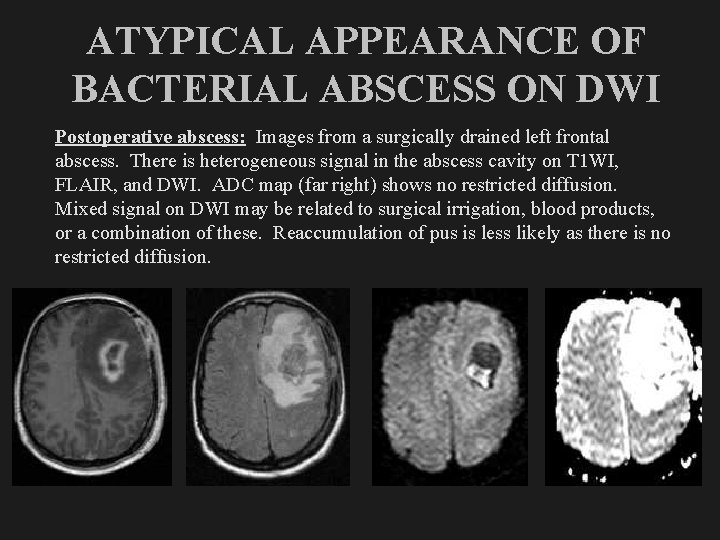 ATYPICAL APPEARANCE OF BACTERIAL ABSCESS ON DWI Postoperative abscess: Images from a surgically drained