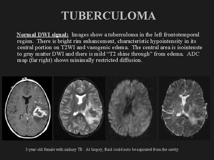 TUBERCULOMA Normal DWI signal: Images show a tuberculoma in the left frontotemporal region. There