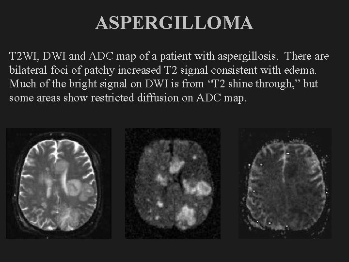 ASPERGILLOMA T 2 WI, DWI and ADC map of a patient with aspergillosis. There