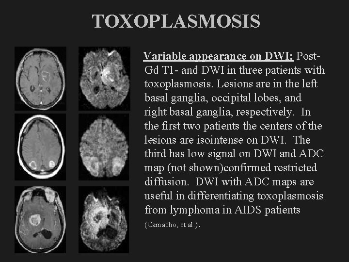 TOXOPLASMOSIS Variable appearance on DWI: Post. Gd T 1 - and DWI in three