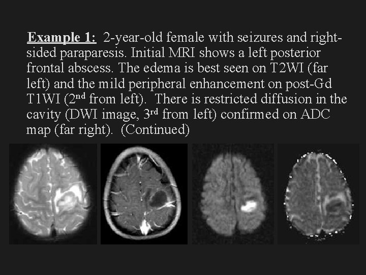 Example 1: 2 -year-old female with seizures and rightsided paraparesis. Initial MRI shows a