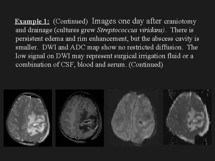 Example 1: (Continued) Images one day after craniotomy and drainage (cultures grew Streptococcus viridans).