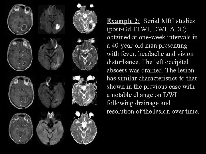 Example 2: Serial MRI studies (post-Gd T 1 WI, DWI, ADC) obtained at one-week