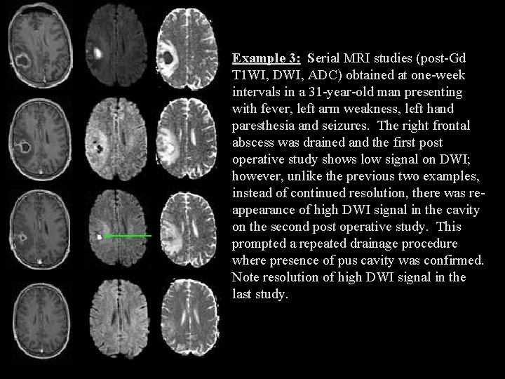 Example 3: Serial MRI studies (post-Gd T 1 WI, DWI, ADC) obtained at one-week