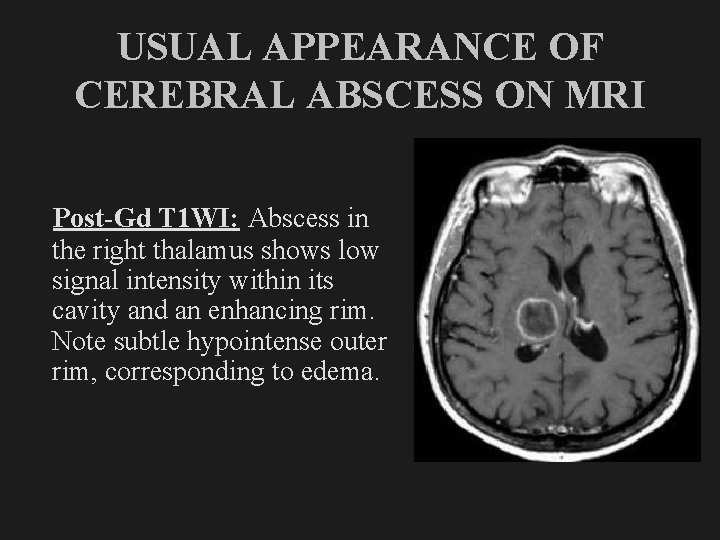 USUAL APPEARANCE OF CEREBRAL ABSCESS ON MRI Post-Gd T 1 WI: Abscess in the