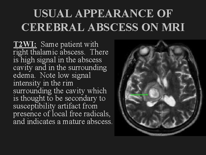 USUAL APPEARANCE OF CEREBRAL ABSCESS ON MRI T 2 WI: Same patient with right