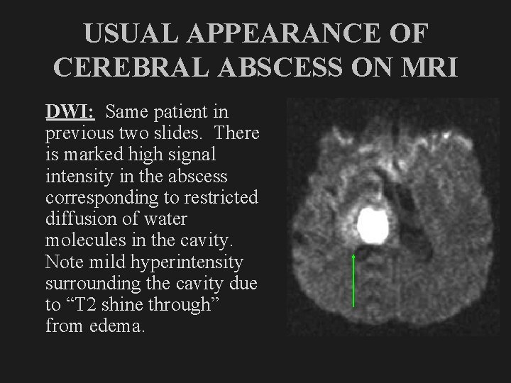 USUAL APPEARANCE OF CEREBRAL ABSCESS ON MRI DWI: Same patient in previous two slides.