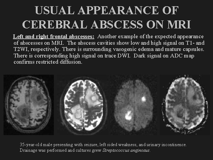 USUAL APPEARANCE OF CEREBRAL ABSCESS ON MRI Left and right frontal abscesses: Another example