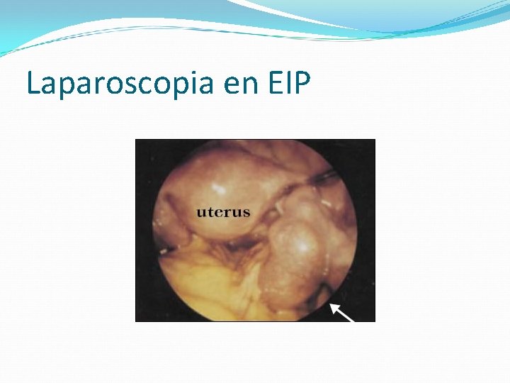 Laparoscopia en EIP 