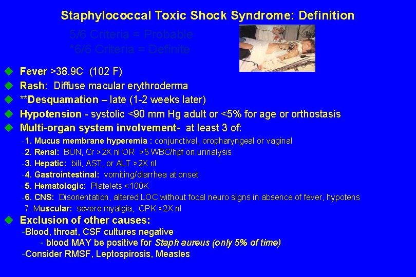 Staphylococcal Toxic Shock Syndrome: Definition 5/6 Criteria = Probable *6/6 Criteria = Definite u