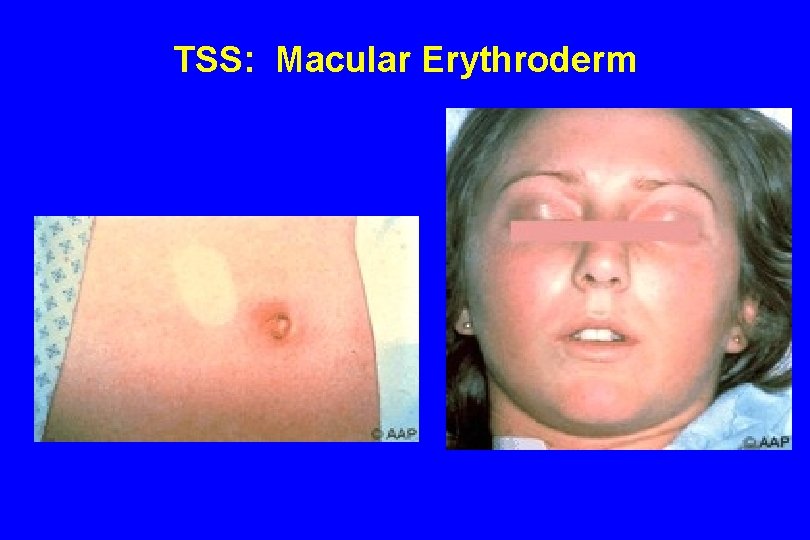 TSS: Macular Erythroderm 