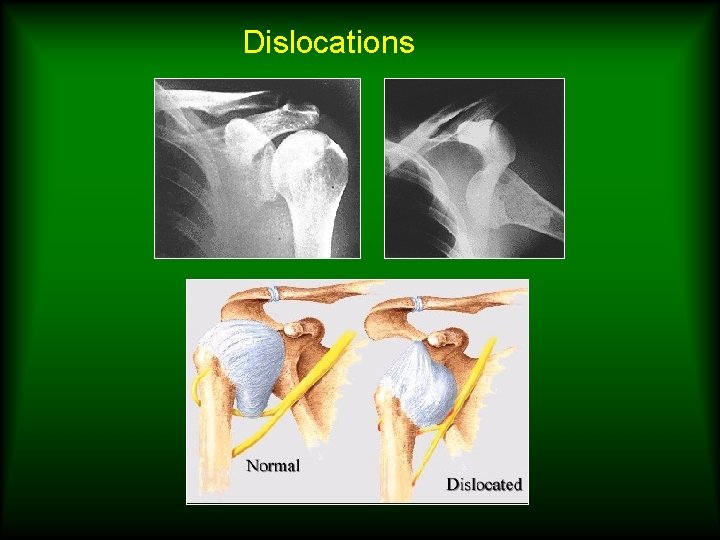 Dislocations 