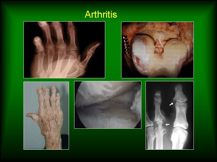 Arthritis 