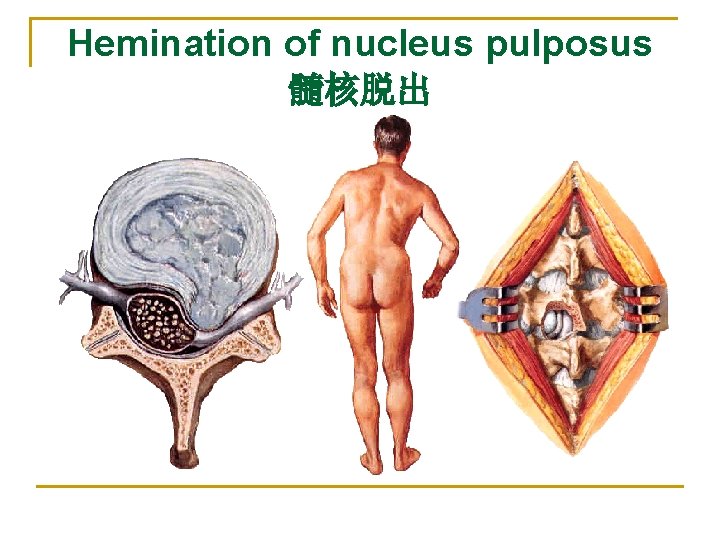 Hemination of nucleus pulposus 髓核脱出 