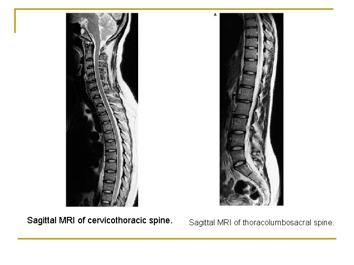 Sagittal MRI of cervicothoracic spine. Sagittal MRI of thoracolumbosacral spine. 