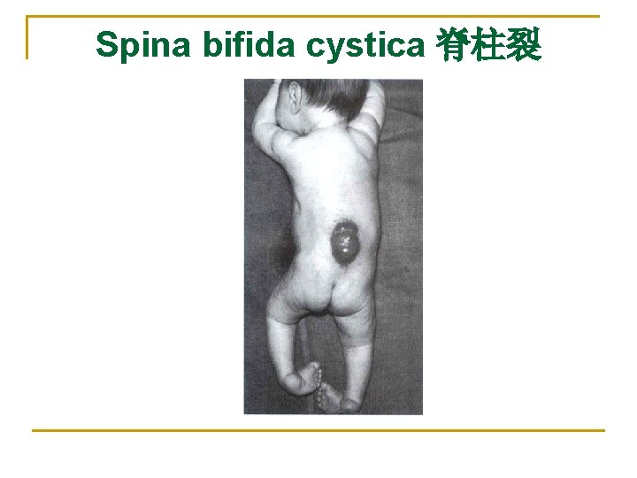 Spina bifida cystica 脊柱裂 