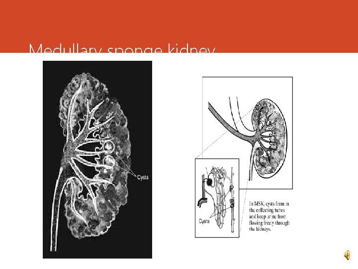 Medullary sponge kidney 