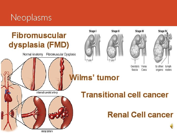 Neoplasms Fibromuscular dysplasia (FMD) Wilms’ tumor Transitional cell cancer Renal Cell cancer 