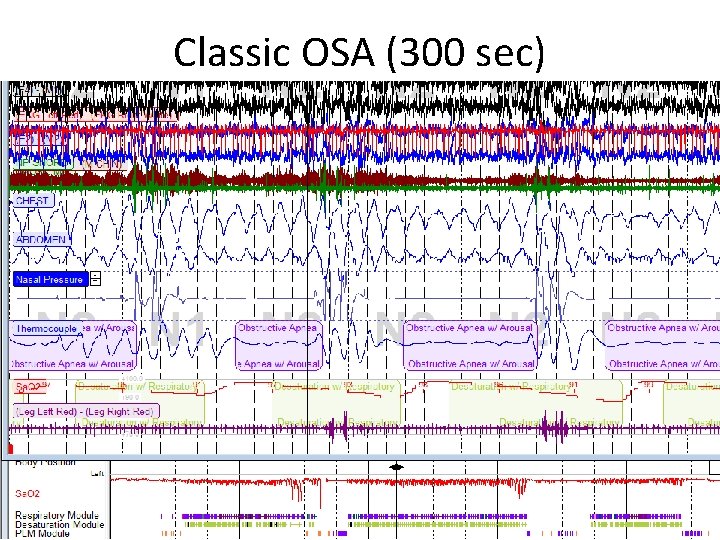 Classic OSA (300 sec) 